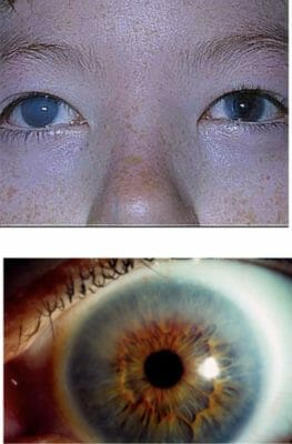 Corneal Clouding in Patients with MPS I
