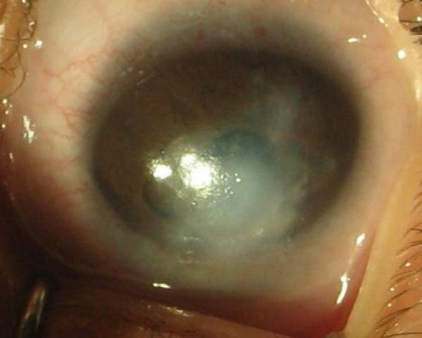 Corneal opacity seen in a case of peters anomaly