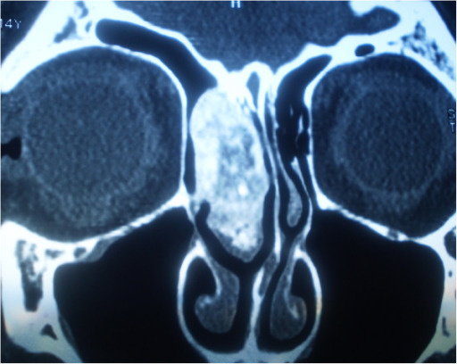 Coronal ct image of an osteoblastoma