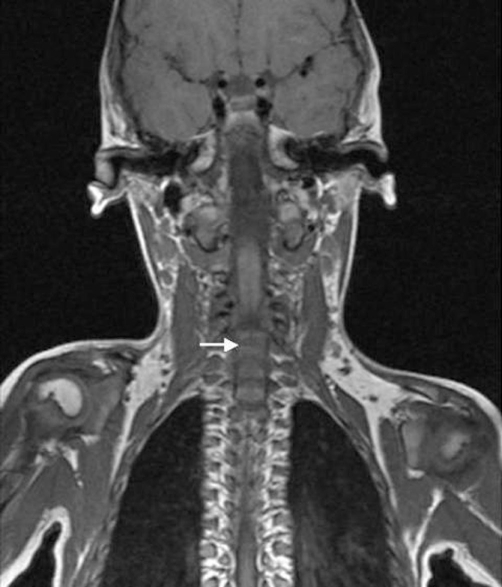 Coronal mri view of the spine