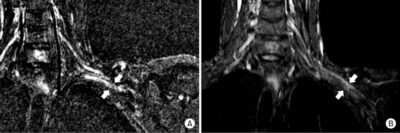 Thoracic Outlet Syndrome | Concise Medical Knowledge