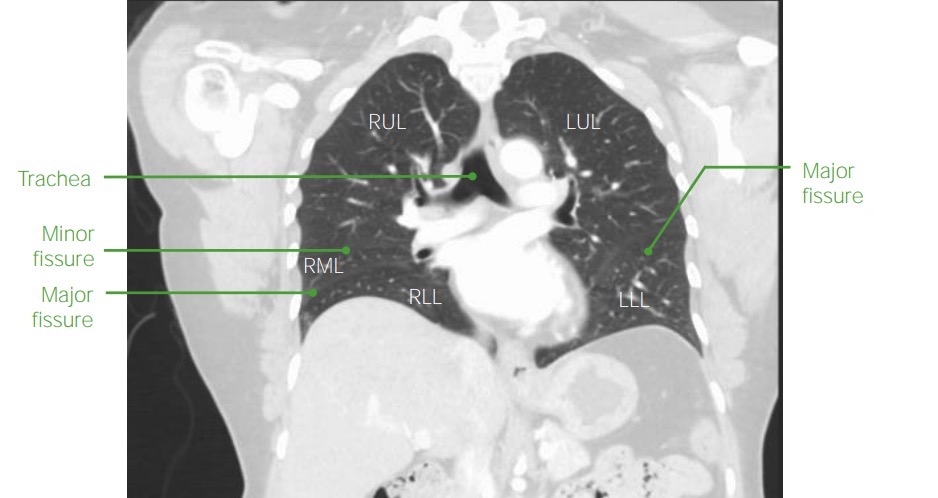 Coronal chest ct with contrast with labels