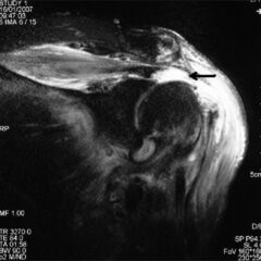 Coronal-oblique T2-weighted magnetic resonance image showing full-thickness rotator cuff tear