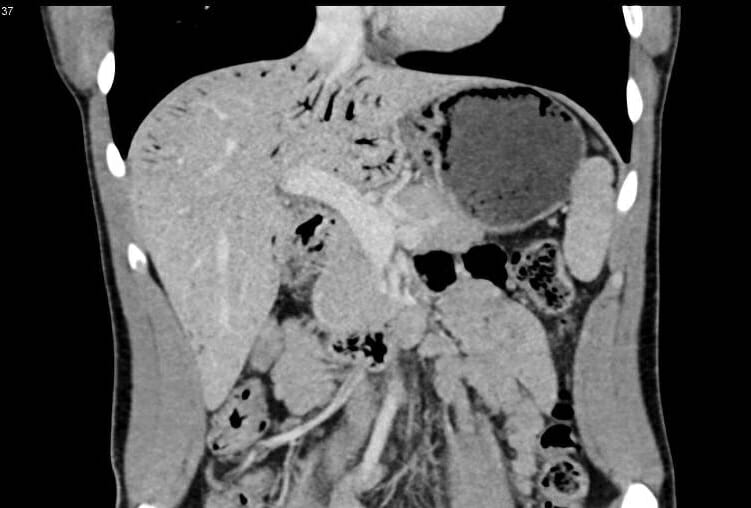 Imagem de tc em fase venosa portal coronal mostrando espessamento da mucosa gástrica
