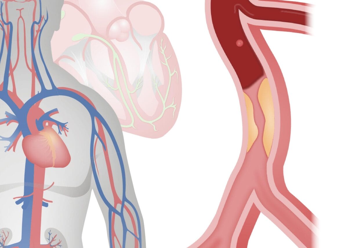 How many have the dreaded “U” pain on the left side? : r/costochondritis