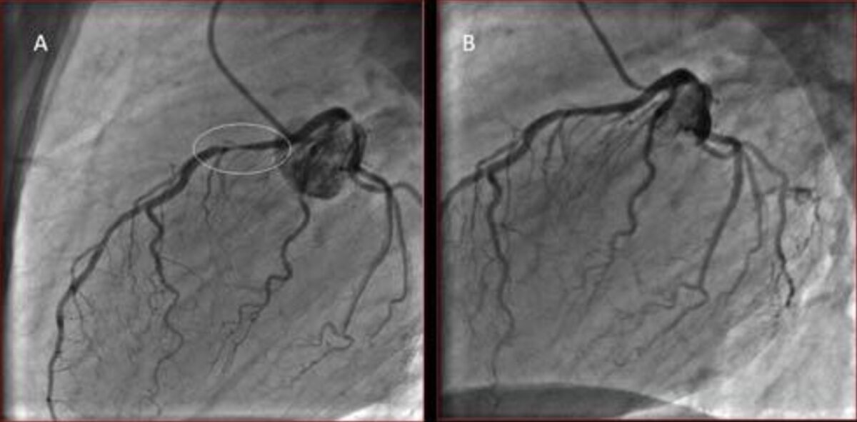 Angiografía coronaria que muestra una estenosis de lad proximal grave