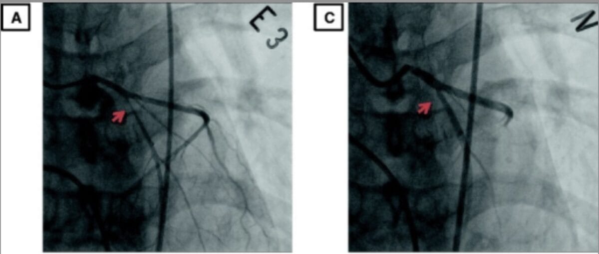 Coronary angiography stenosis