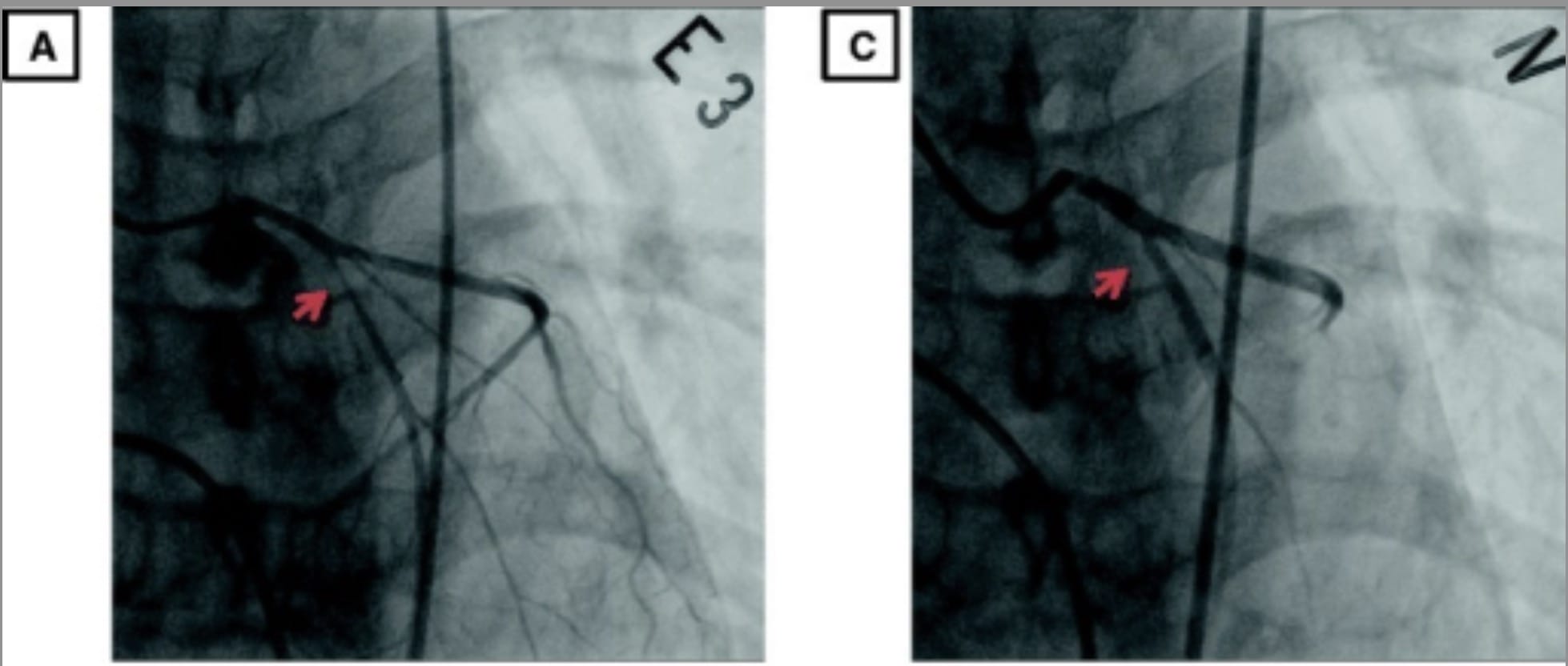 How many have the dreaded “U” pain on the left side? : r/costochondritis