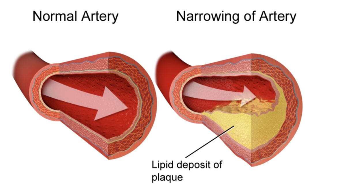 Coronary artery disease