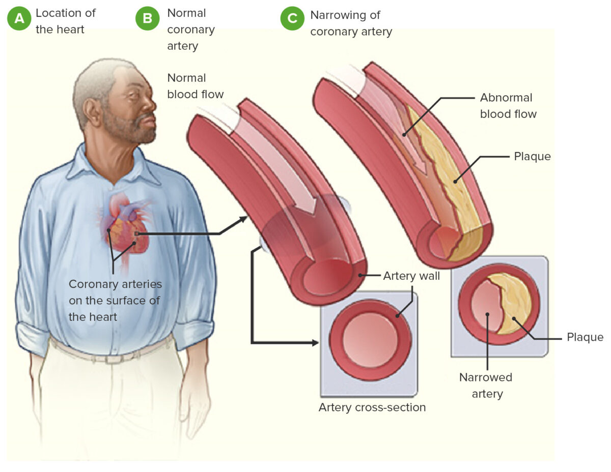 Fisiopatología de la cardiopatía coronaria