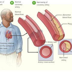 Coronary heart disease pathophysiology