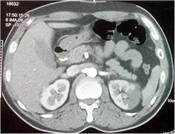 Cortex of the left kidney