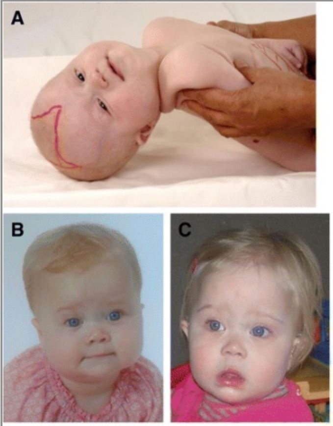 Zellweger Syndrome | Concise Medical Knowledge