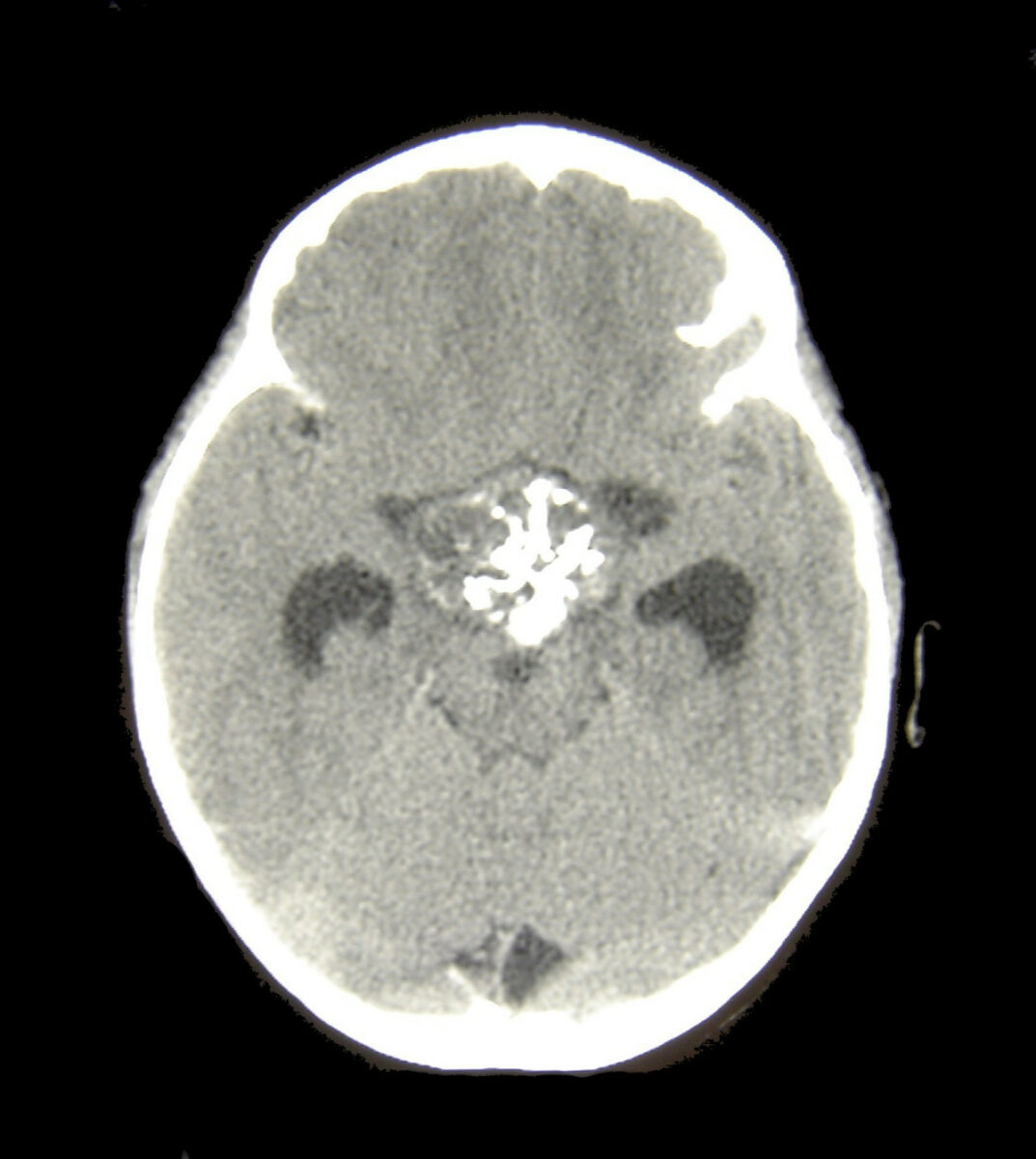 Craniopharyngioma ct