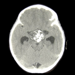 Craniopharyngioma CT