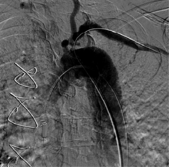 Critical ostial subclavian artery stenosis