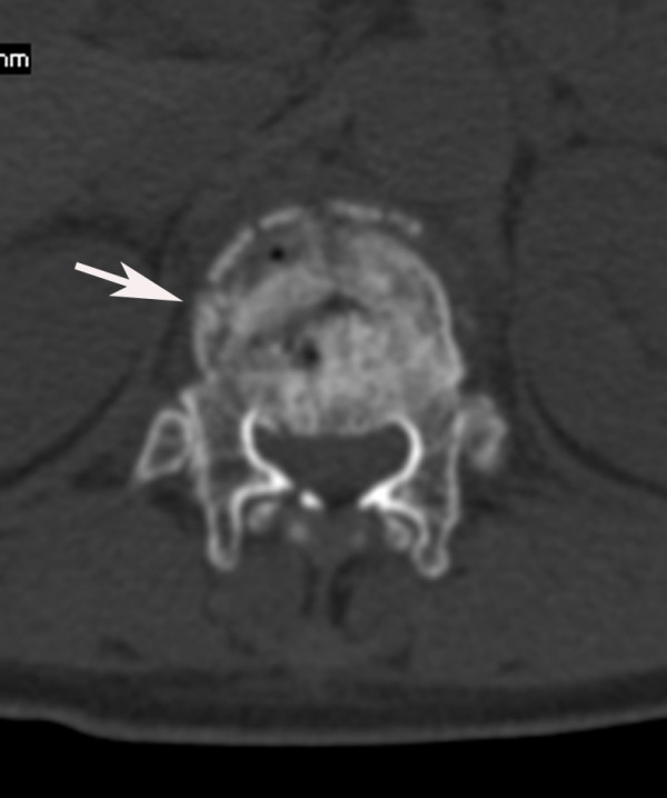 Cross-sectional image shows burst fracture of t12