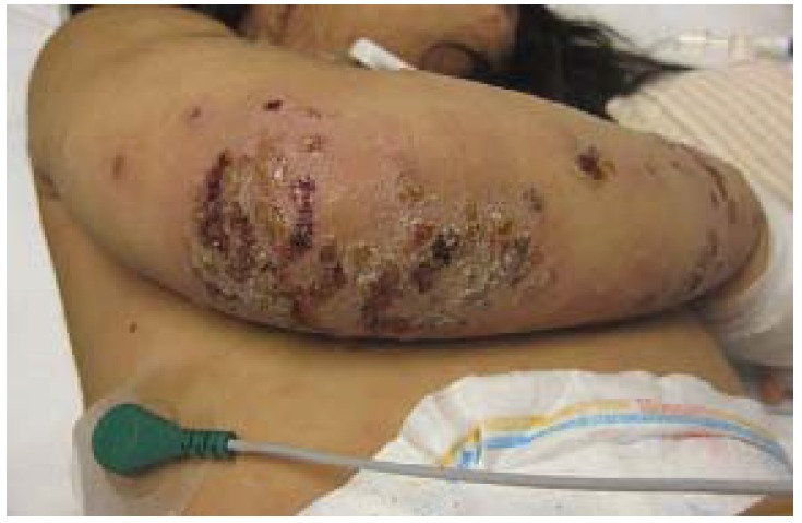 Crusted, nonbullous impetigo on the upper extremity of a pediatric patient