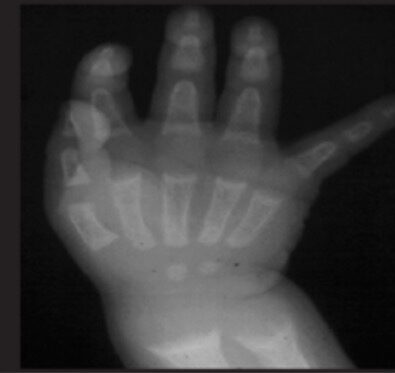 Cupping and brush−like structure of epiphyses in rickets