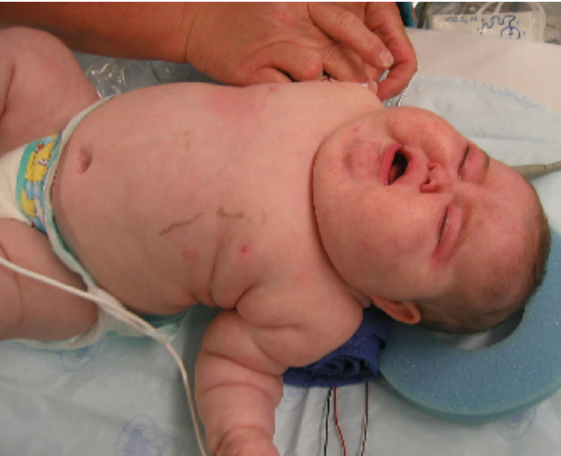 Cushing syndrome baby
