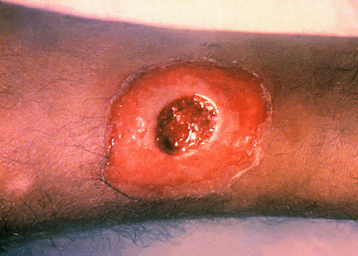 Cutaneous diphtheria chronic non-healing ulcer