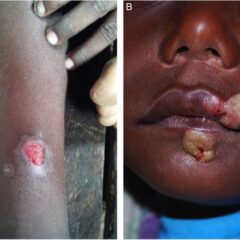 Cutaneous lesions of primary yaws