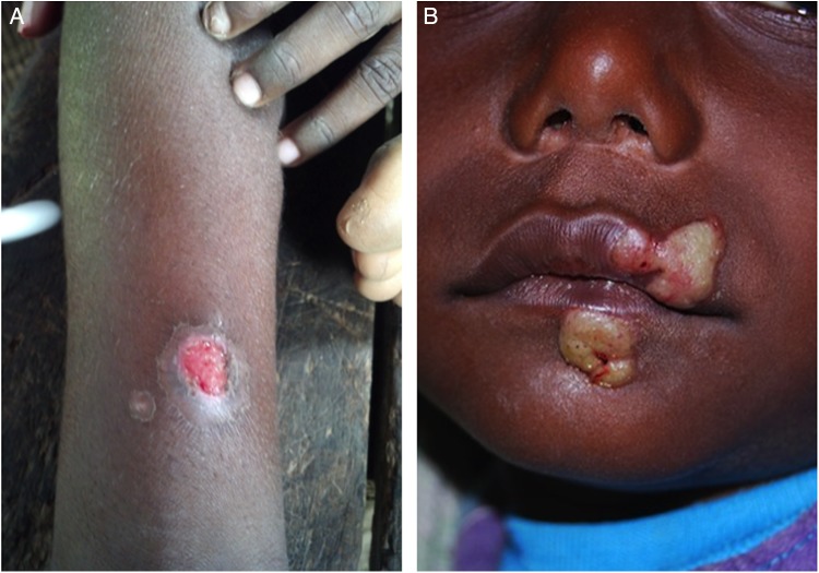 Cutaneous lesions of primary yaws