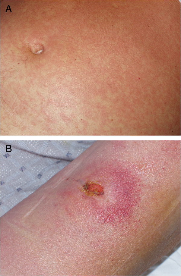 Cutaneous manifestations of african trypanosomiasis