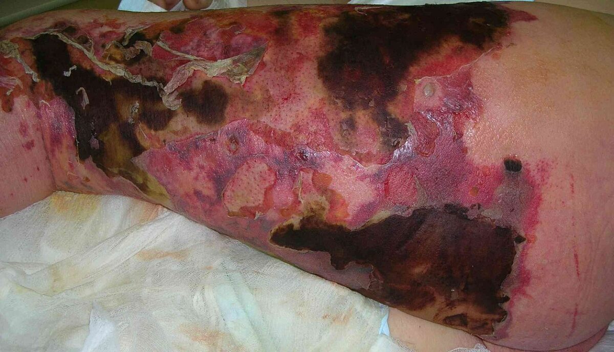 Cutaneous necrosis, erythema and bullous changes due to necrotizing fasciitis of the leg