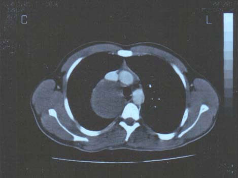 Cyst in the posteromedial mediastinum