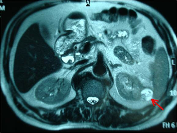 Cystic renal cell carcinoma