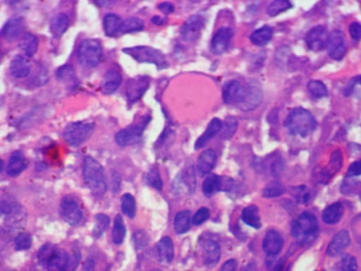 Cytodiagnosis of multiple myeloma