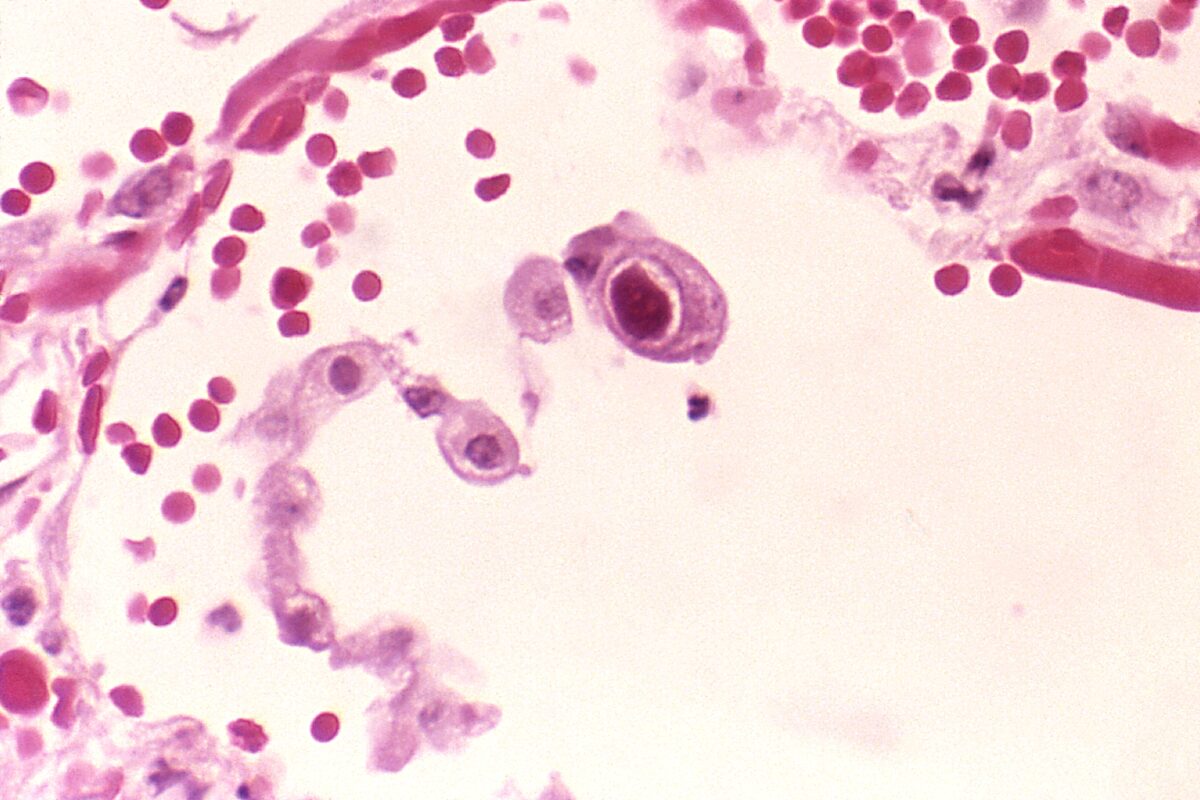 Cytomegalovirus infection of a human lung