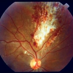 Cytomegalovirus retinitis