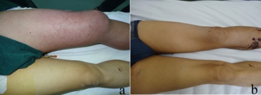 Mujer vistiendo debajo de la rodilla longitud TED TVP ( trombosis