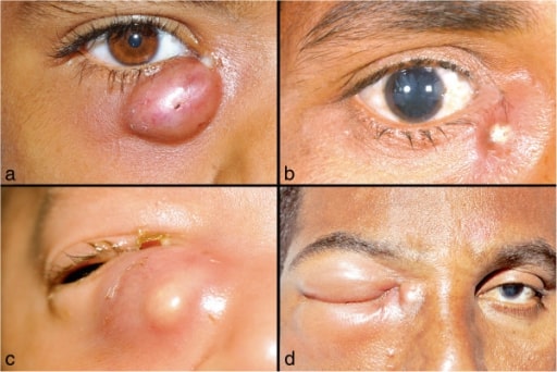 Dacryocystitis clinical presentation