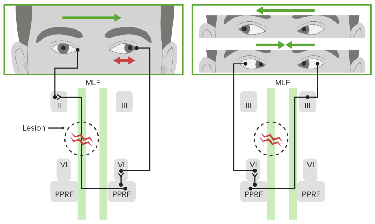 Defecto de la visión horizontal en la oftalmoplejia internuclear