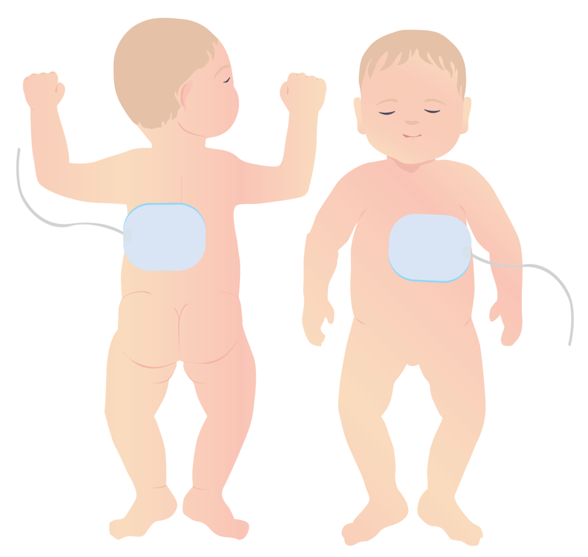 Defibrillator pad placement for infants-01