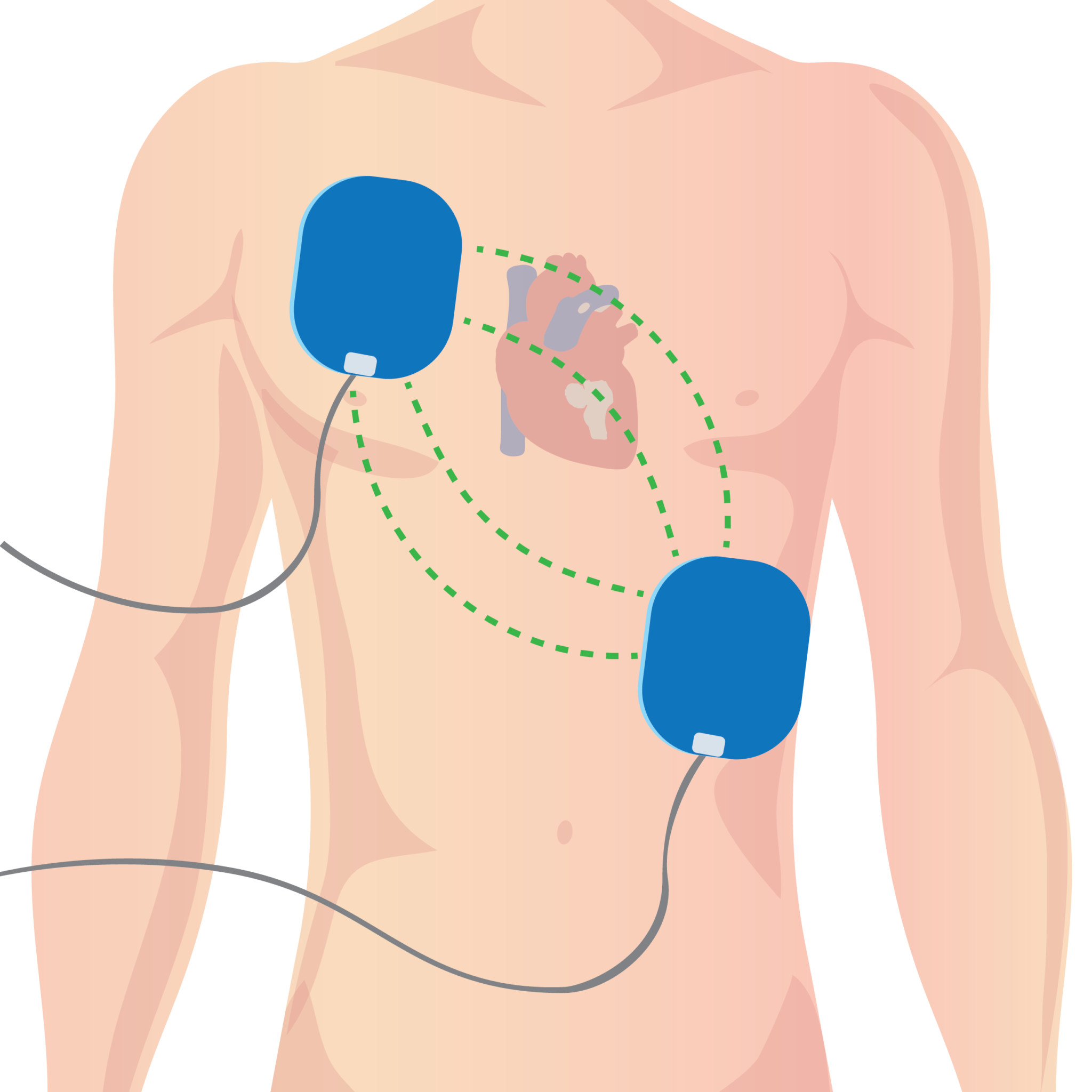 Cardiopulmonary Resuscitation (CPR) Concise Medical Knowledge
