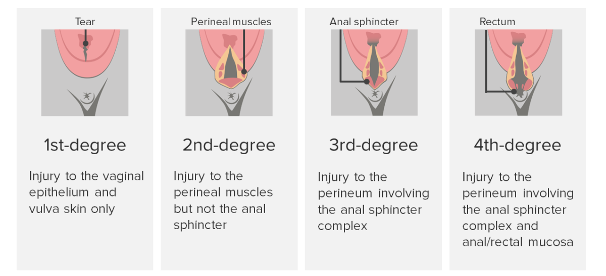 Degrees of perineal lacerations