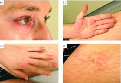 Paraneoplastic Leg Rash Paraneoplastic Syndromes | Concise Medical Knowledge