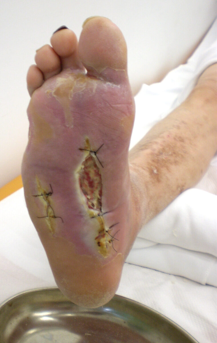 Diabetic foot syndrome