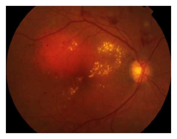 Diabetic retinopathy in ophtalmic exam