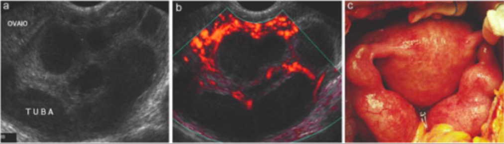 pelvic inflammatory disease ultrasound