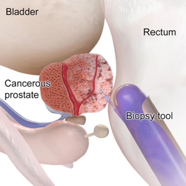 prostate cancer complications usmle)