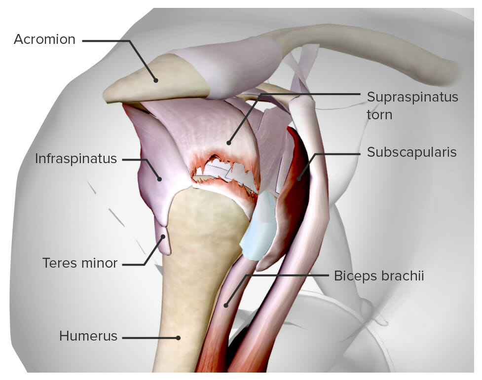 Diagram depicting torn supraspinatus tendon