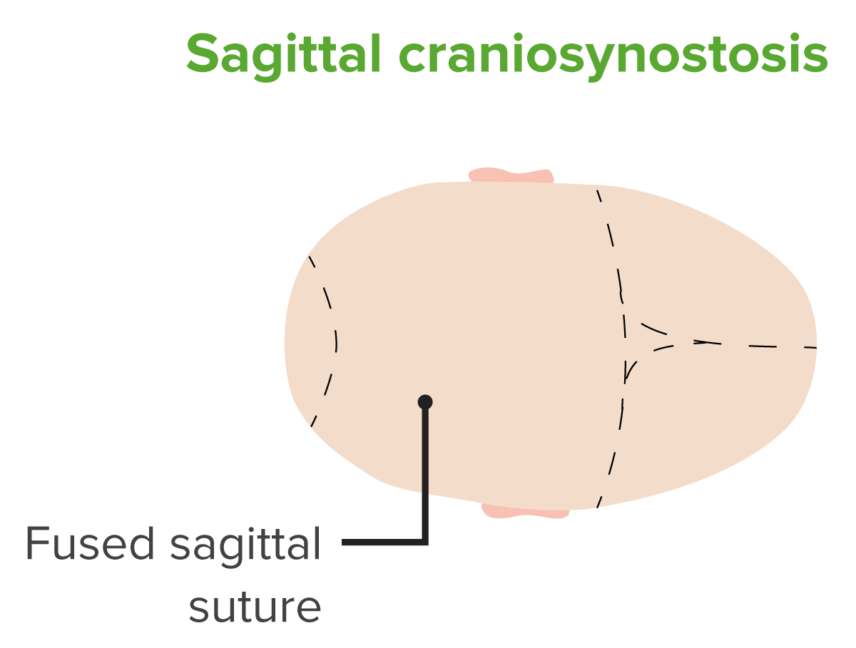 Diagram of a head with sagittal craniosynostosis