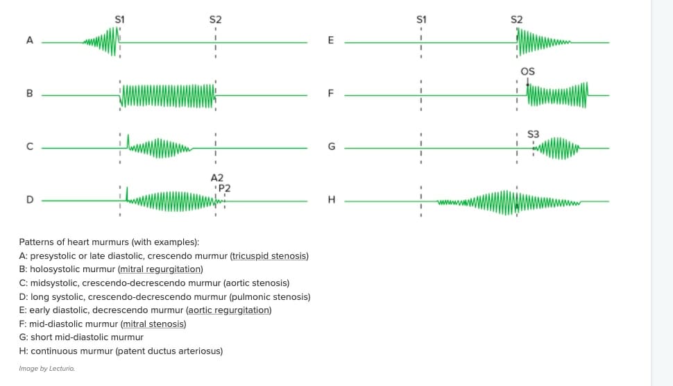Diagram of audio heart sounds