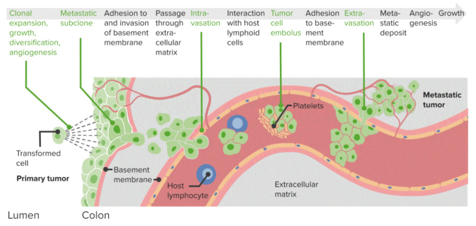 Diagram of cancer metastasis or malignant neoplasms