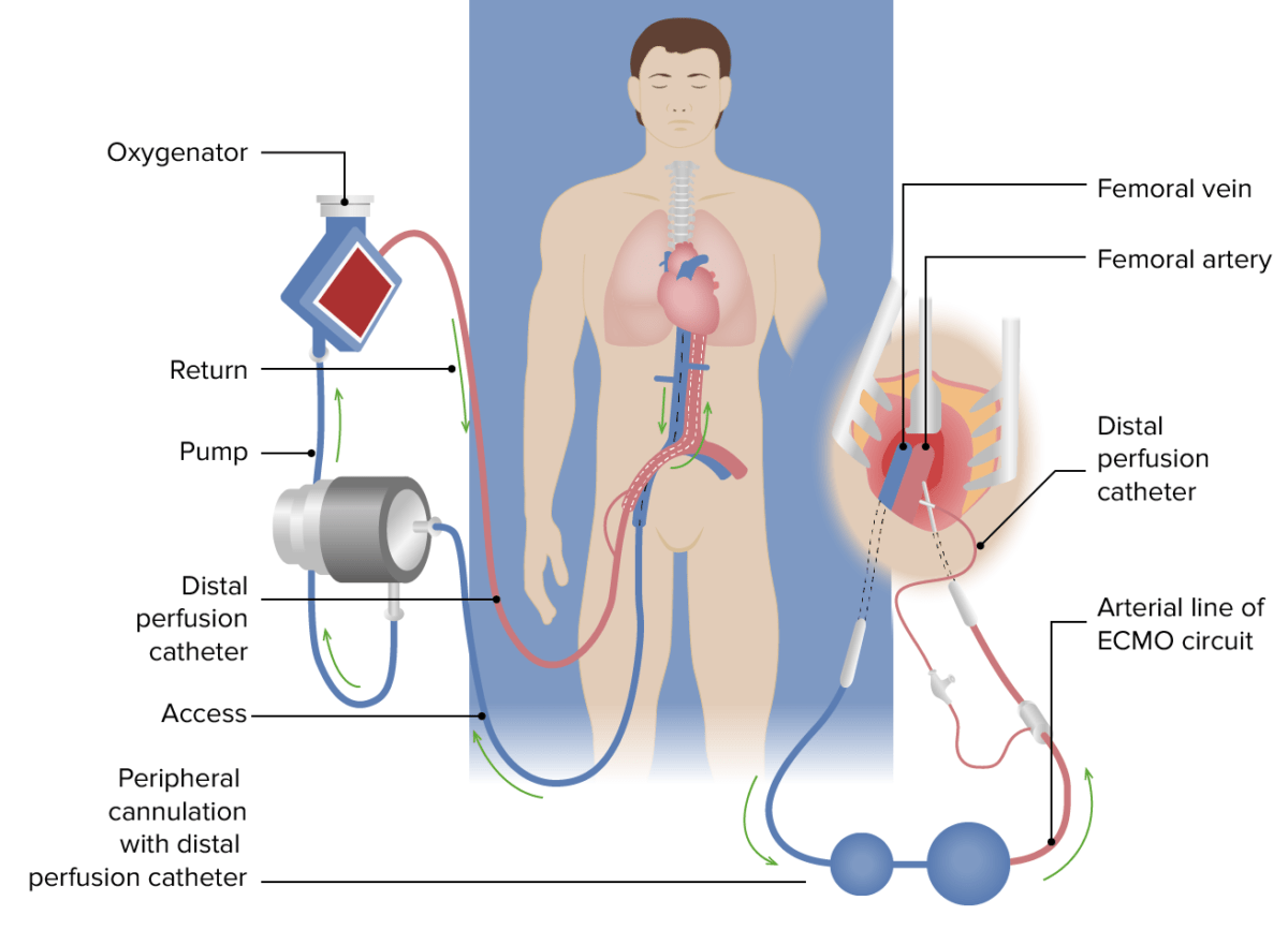Diagram of venovenous ecmo for respiratory failure